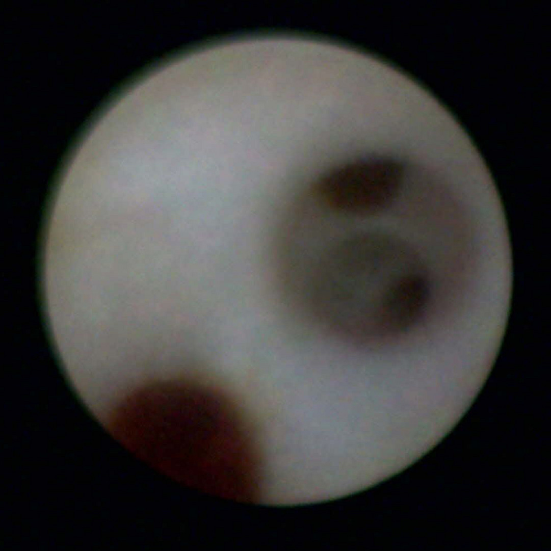 Endoskopisches Bild mit 6.000 Pixel-Optik