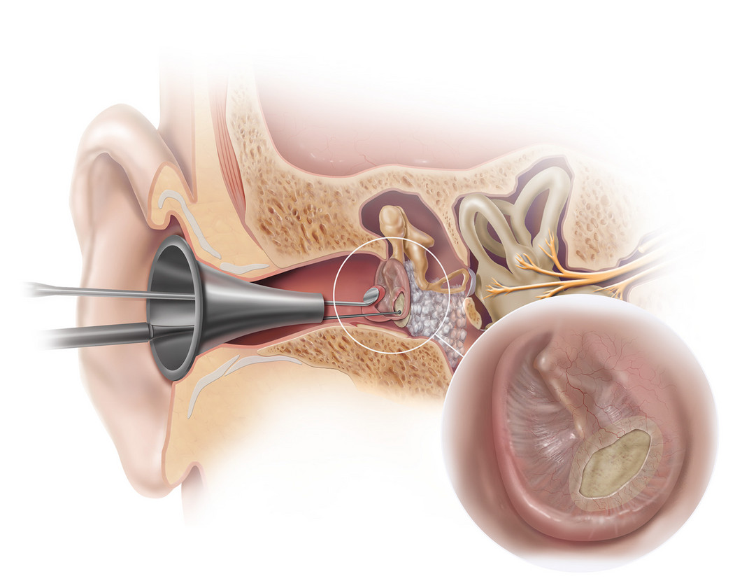 Das Everis™ Biodesign® Otologic Repair Graft Implantat dient dem Verschluss von Trommelfellperforationen. Das Everis™ Biodesign® Otologic Repair Graft Implantat dient dem Verschluss von Trommelfellperforationen.