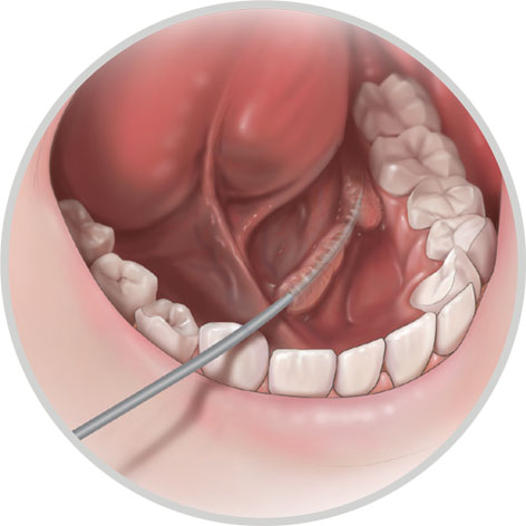 Dilatator-Set für den Zugang zum Speicheldrüsengang Dilatator-Set für den Zugang zum Speicheldrüsengang