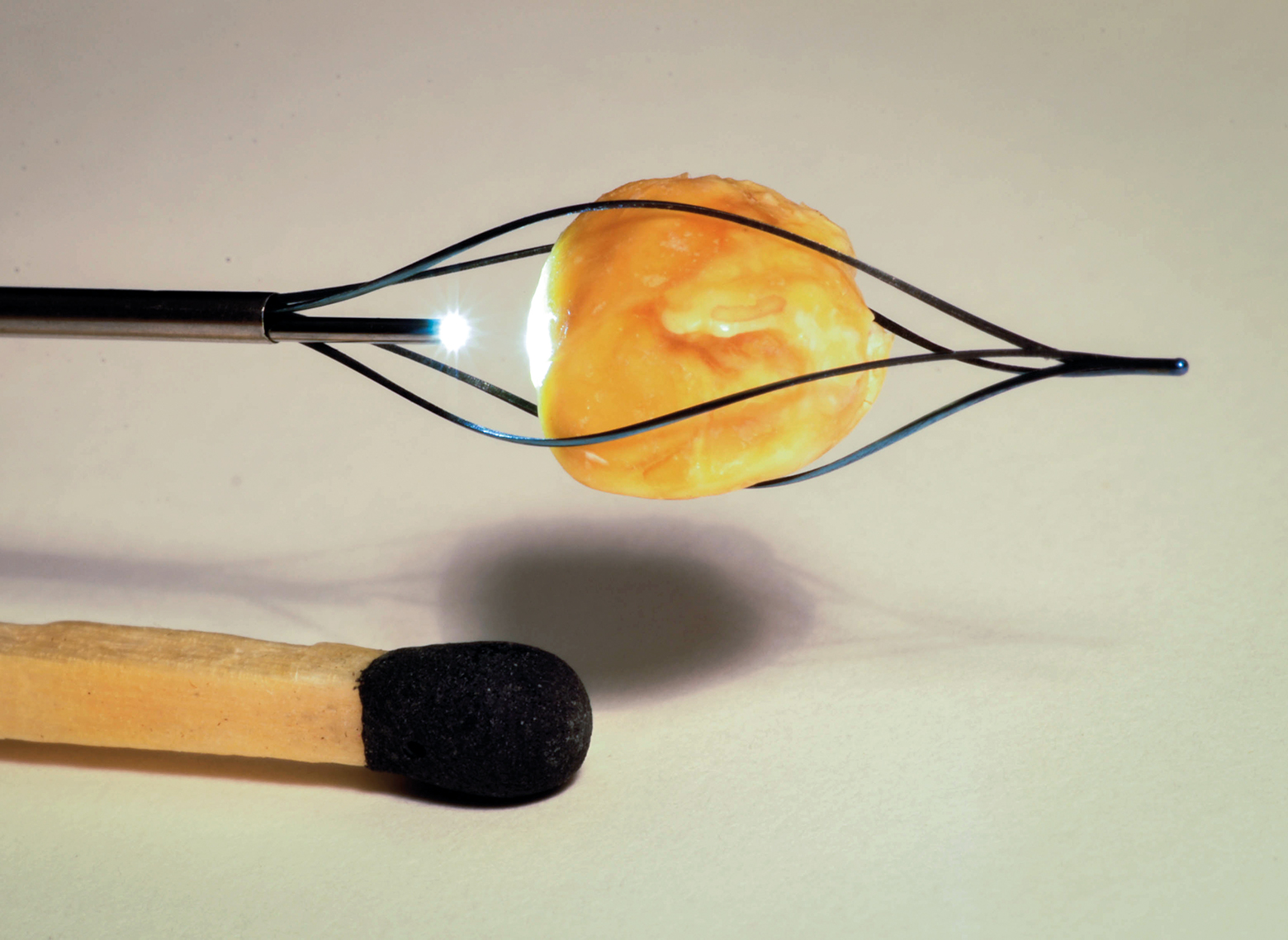 Speichelstein im Steinfängerkörbchen