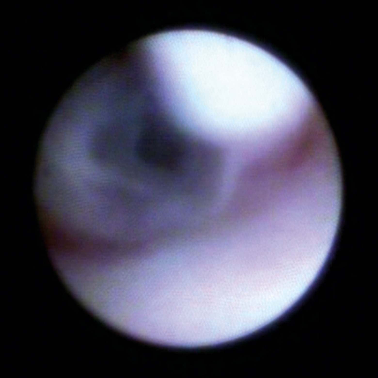 Endoskopisch kontrollierter Einsatz des Mikrodrills