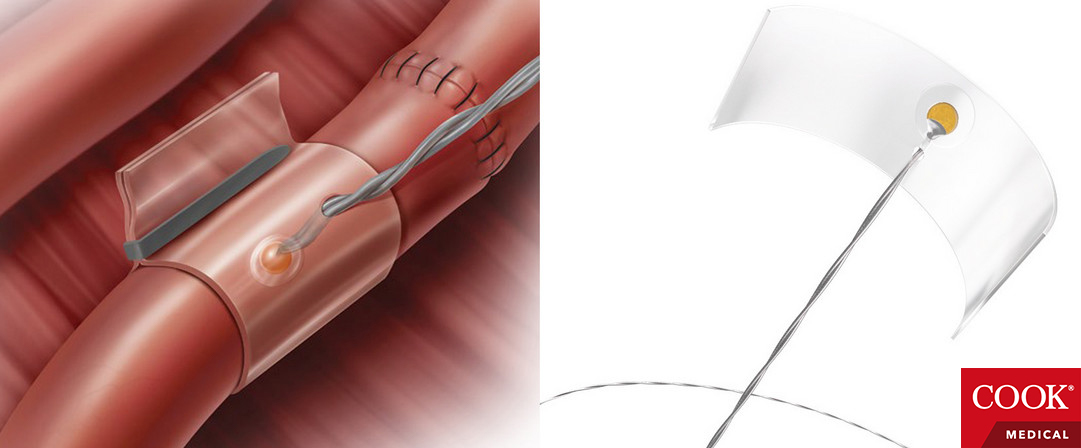Doppler Blood Flow Monitoring System Doppler Blood Flow Monitoring System