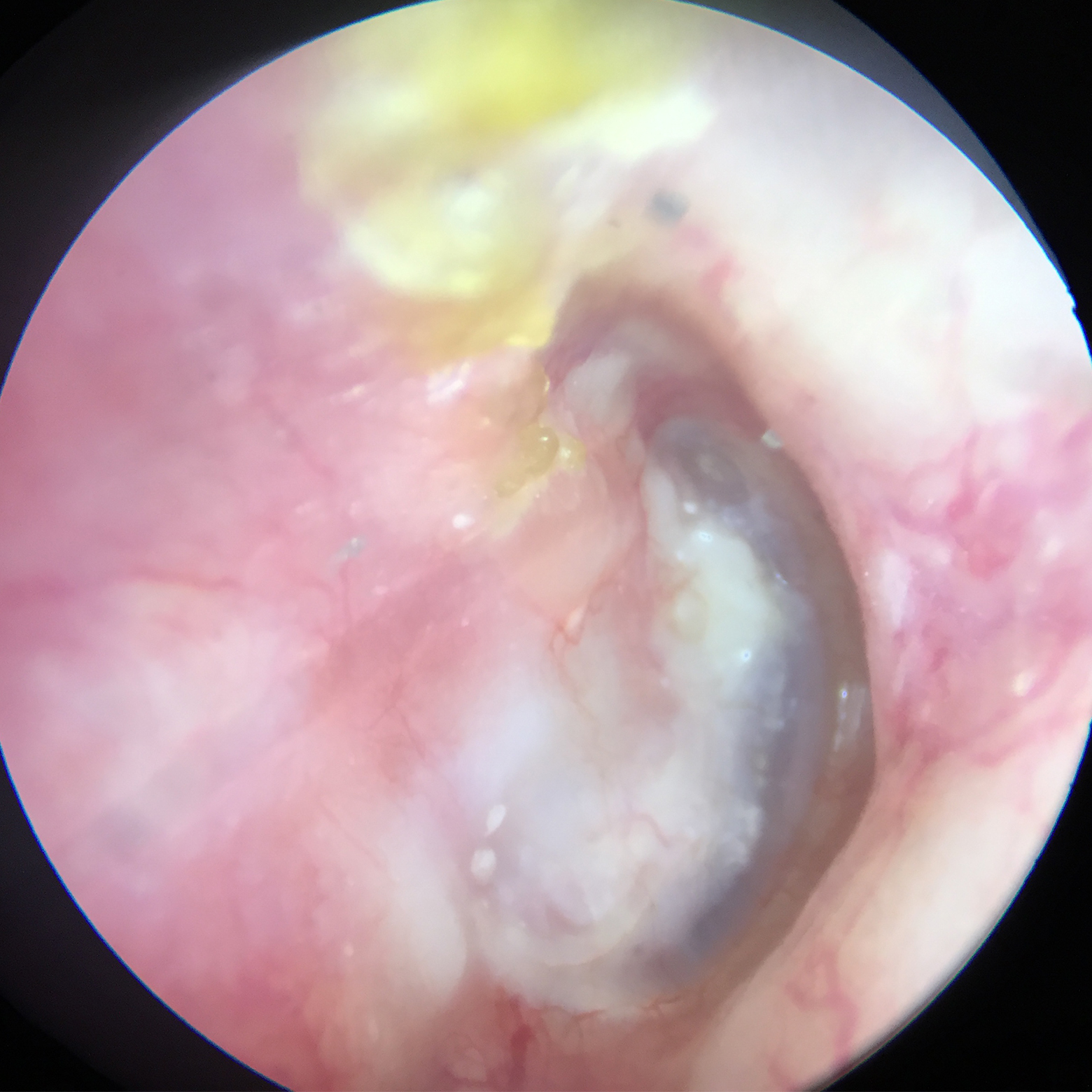 1 Jahr postoperativ Cholesteatomoperation - 1 Jahr postoperativ