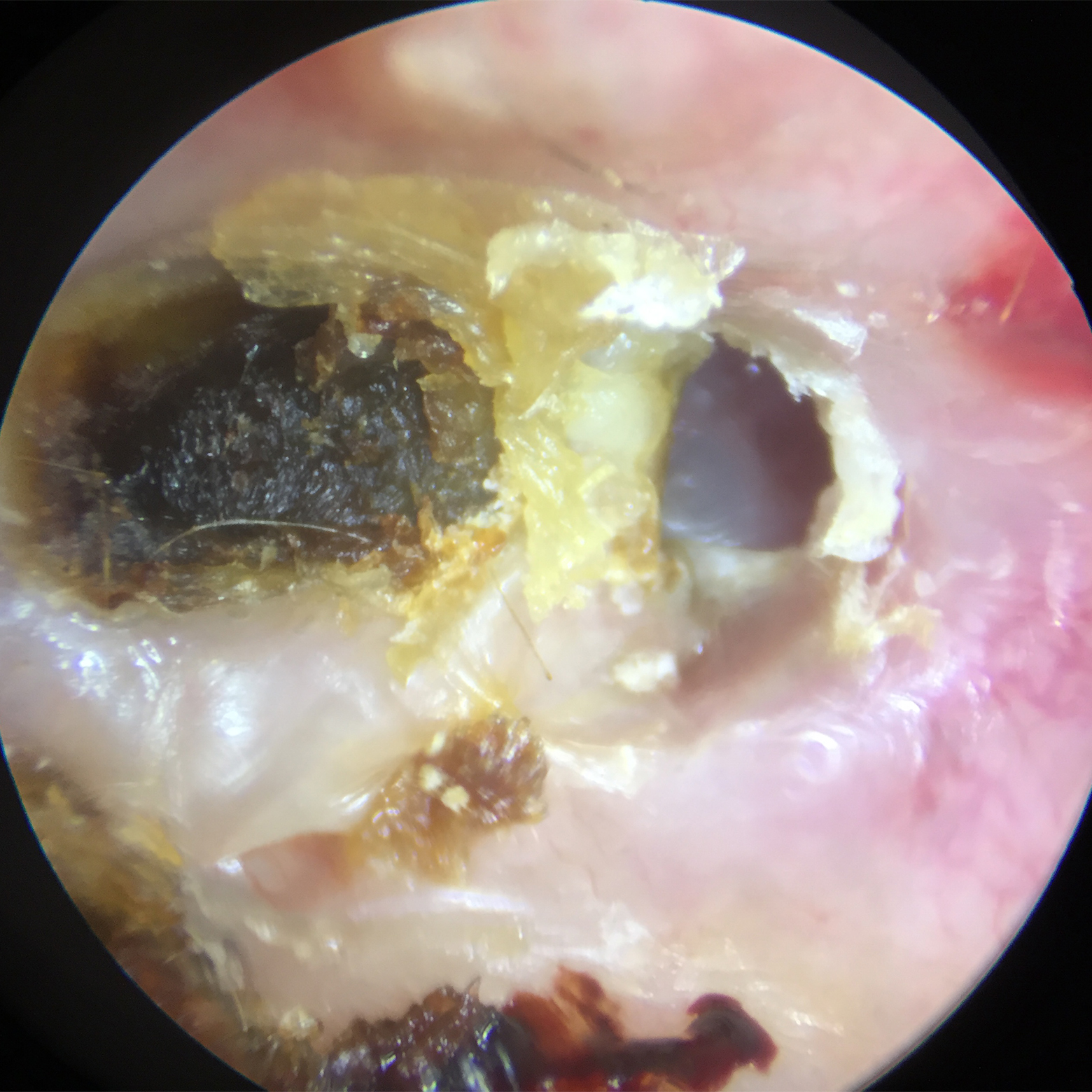präoperativ Cholesteatomoperation - präoperativ
