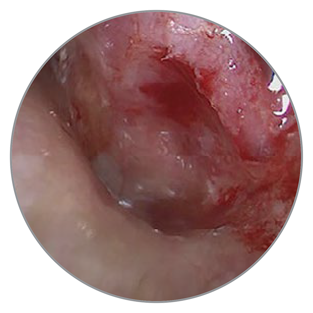 40 Tage nach der OP 40 Tage nach der OP