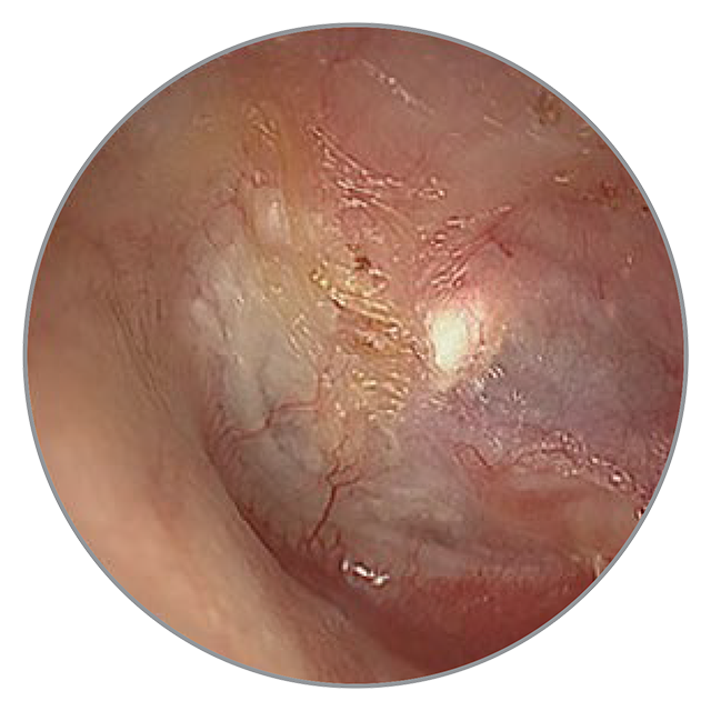 60 Tage nach der OP 60 Tage nach der OP