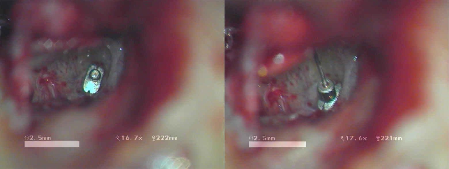 Ω Connector in situ