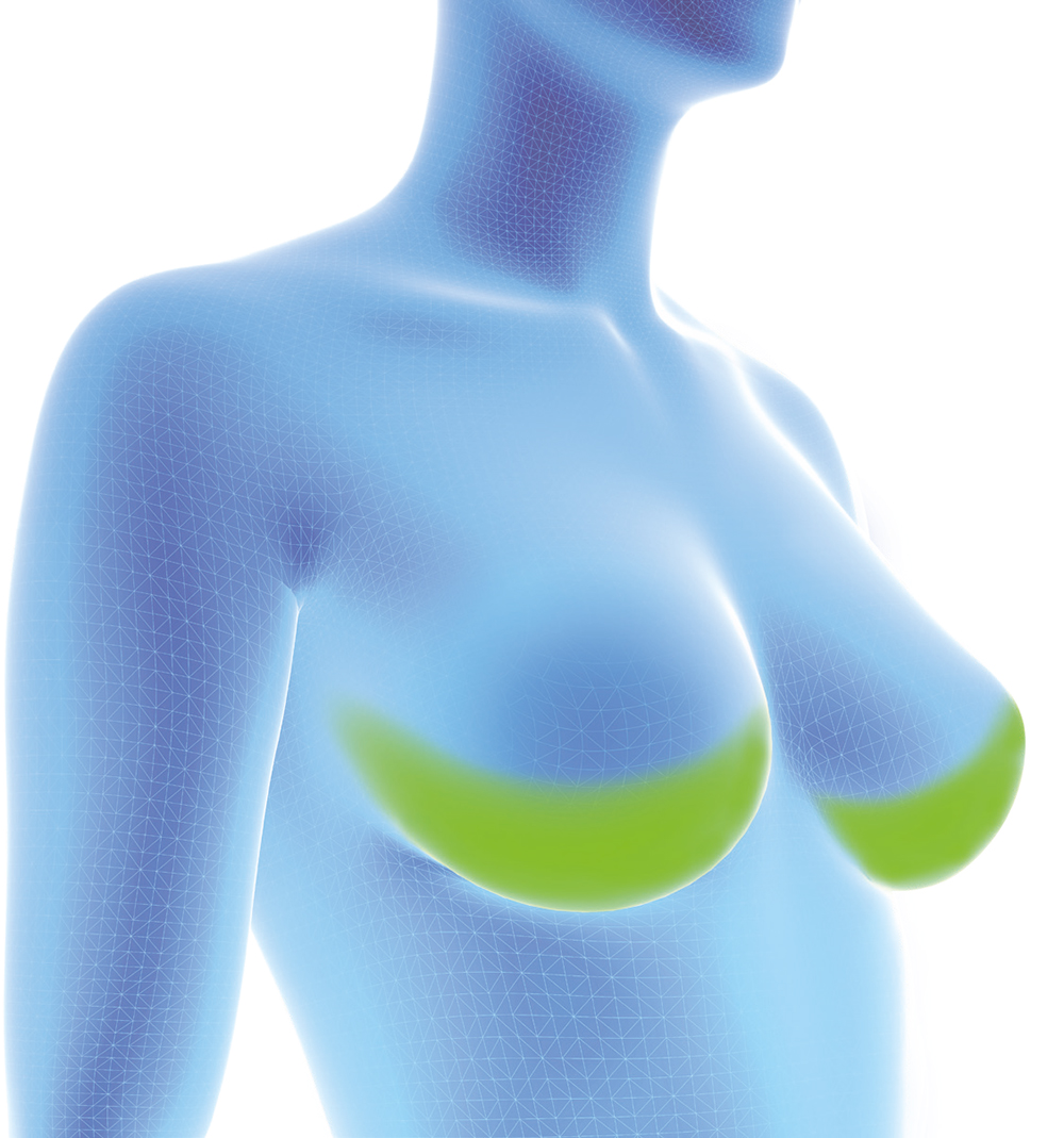 Subpektorales Verfahren Subpektorales Verfahren