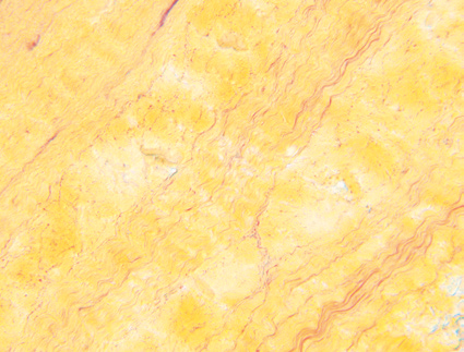 Vor der Implantation Vor der Implantation