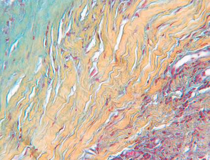 36 Monate nach der Implantation 36 Monate nach der Implantation