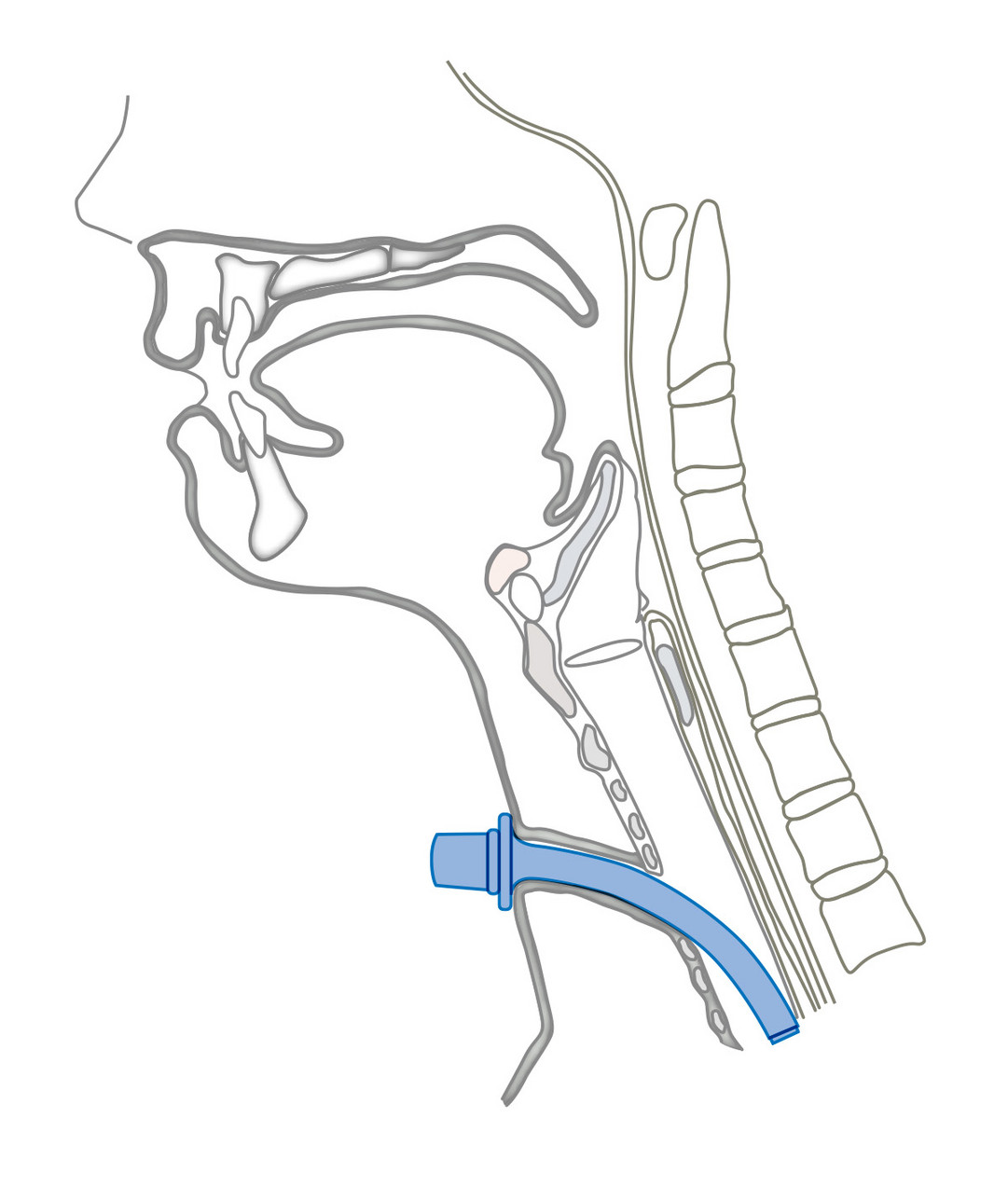 Moore Trachealkanüle Moore Trachealkanüle