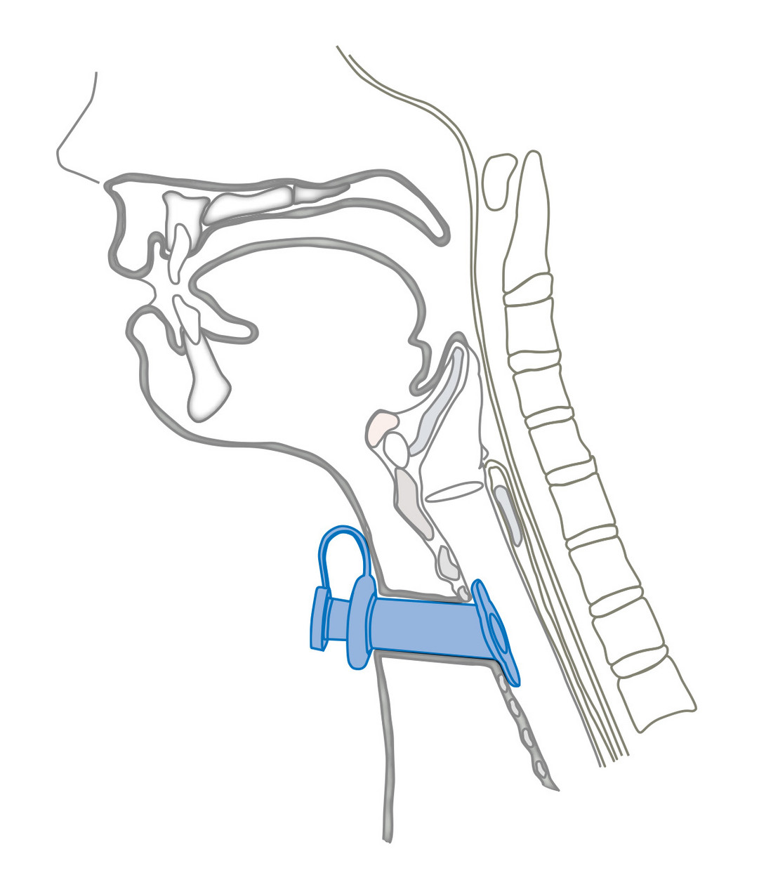 Montgomery Langzeitkanüle Montgomery Langzeitkanüle