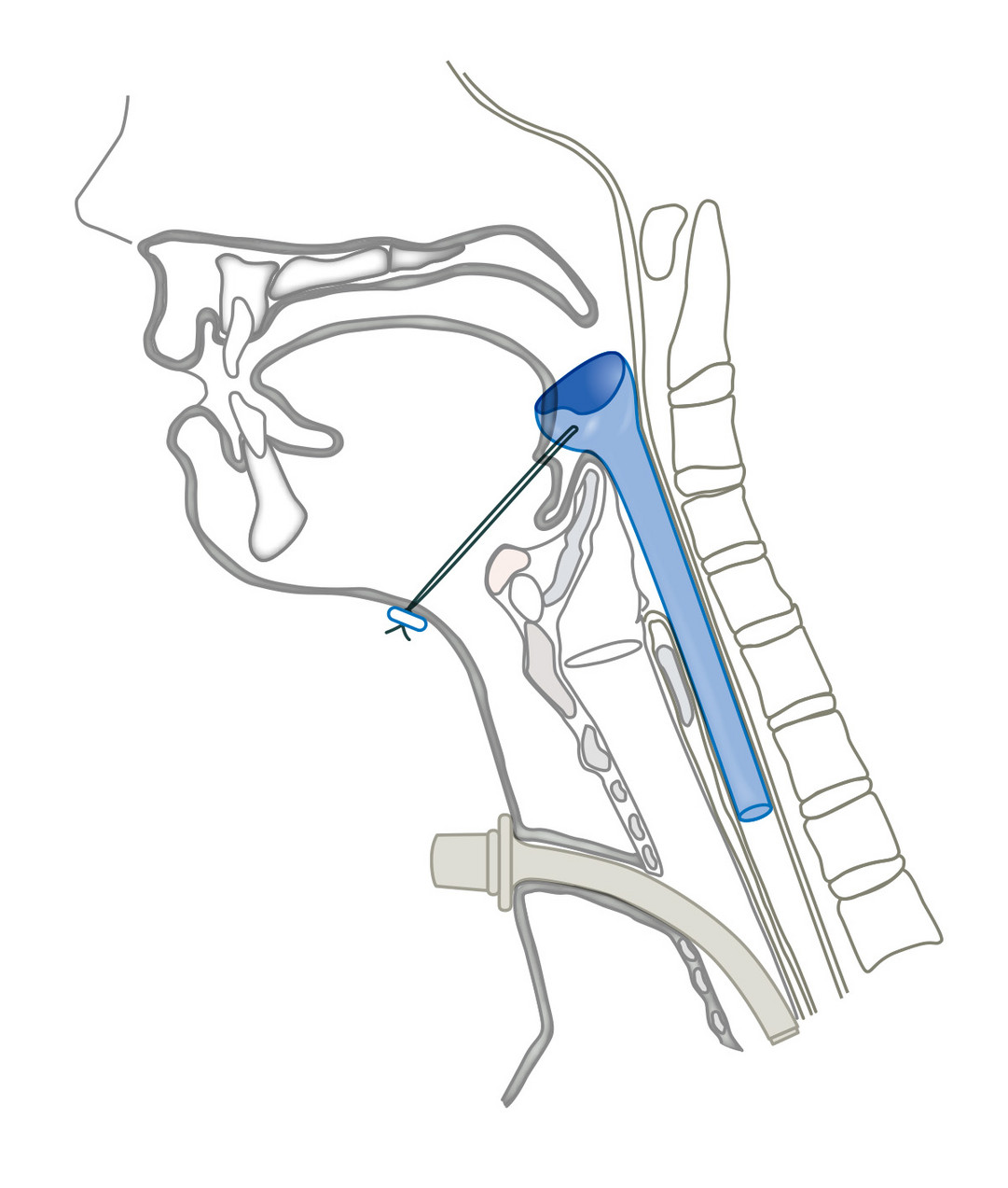 Har-El Pharynx Speichel-Bypass-Tubus Har-El Pharynx Speichel-Bypass-Tubus
