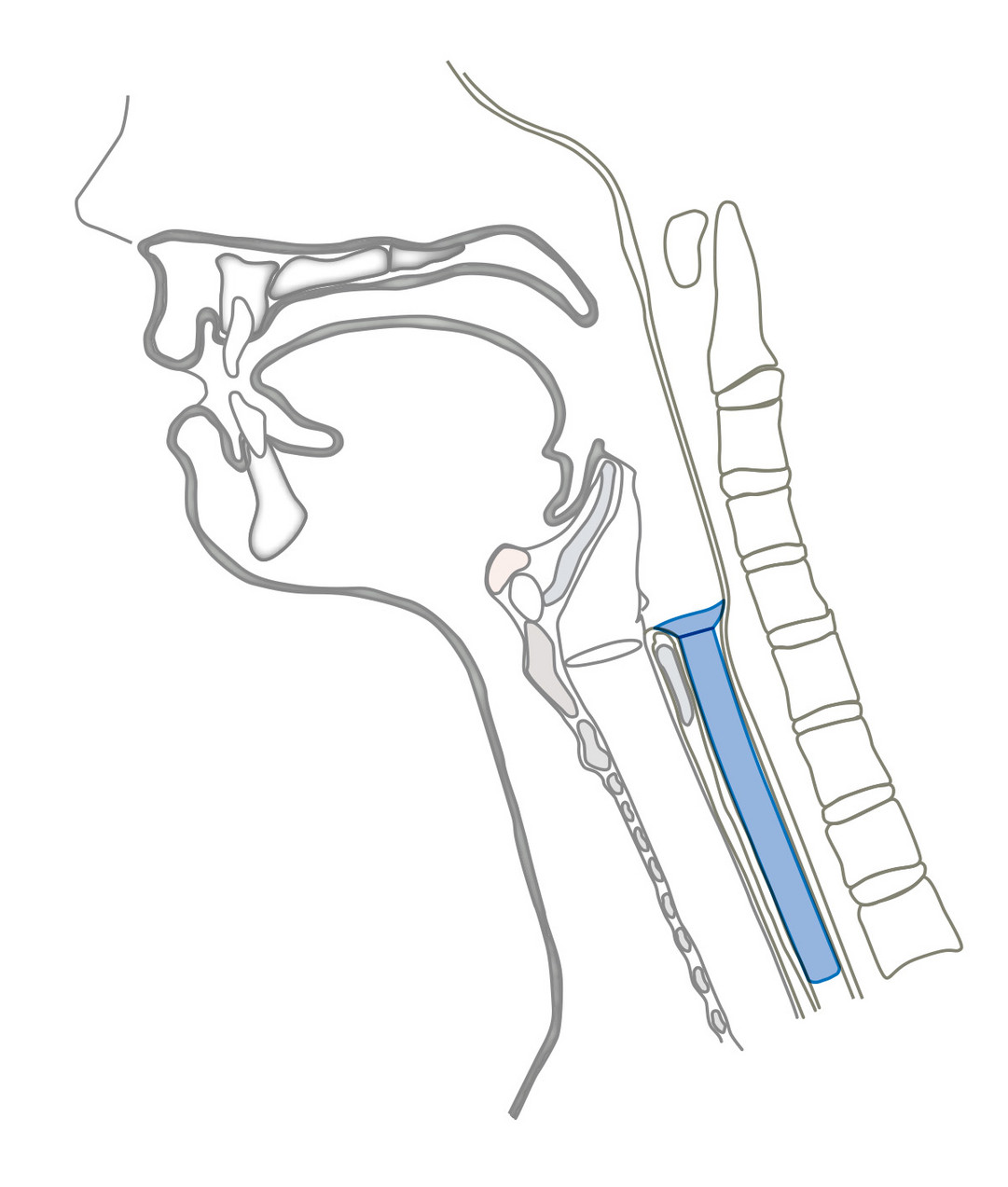 Montgomery Speichel-Bypass-Tubus Montgomery Speichel-Bypass-Tubus