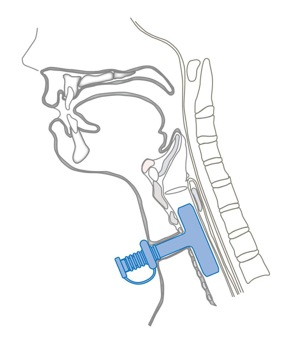 Montgomery Safe-T-Tubus Montgomery Safe-T-Tubus
