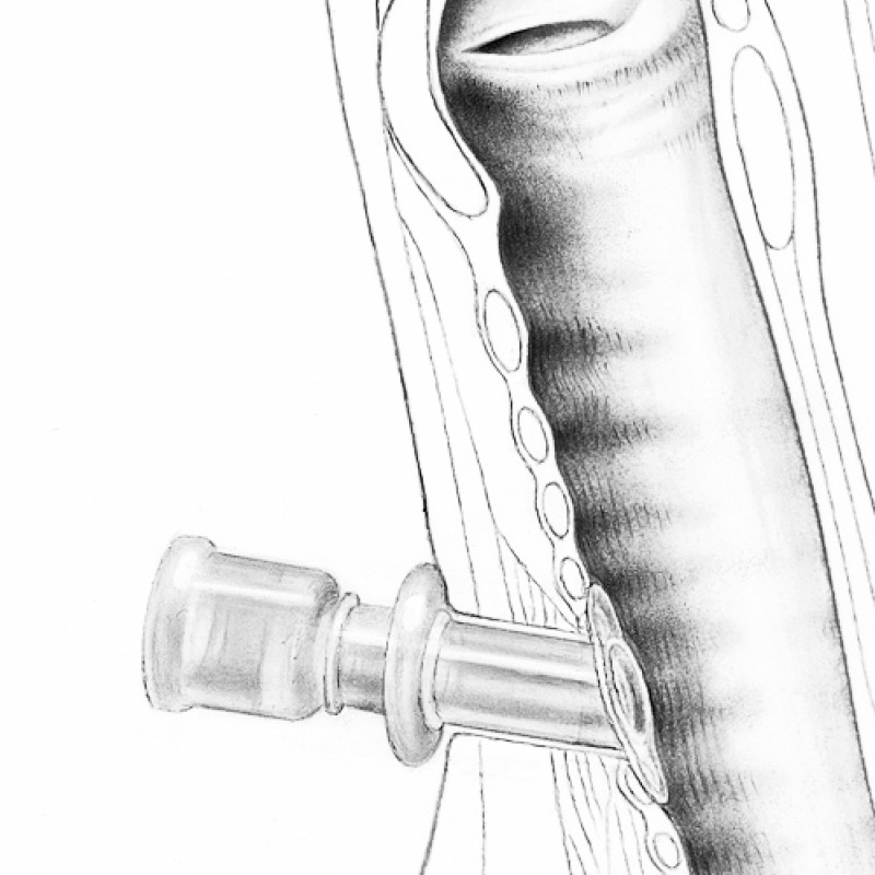 Hochpolierte Oberfläche, die das Wachstum des Epithels zwischen der Luftröhre und der Haut ermöglicht und fördert. Hochpolierte Oberfläche, die das Wachstum des Epithels zwischen der Luftröhre und der Haut ermöglicht und fördert.