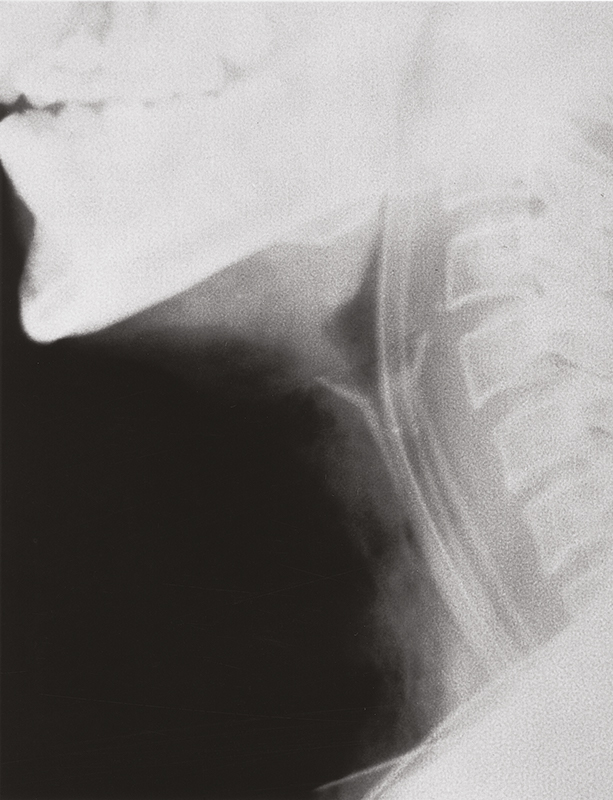 Montgomery Speichel-Bypass-Tubus Montgomery Speichel-Bypass-Tubus