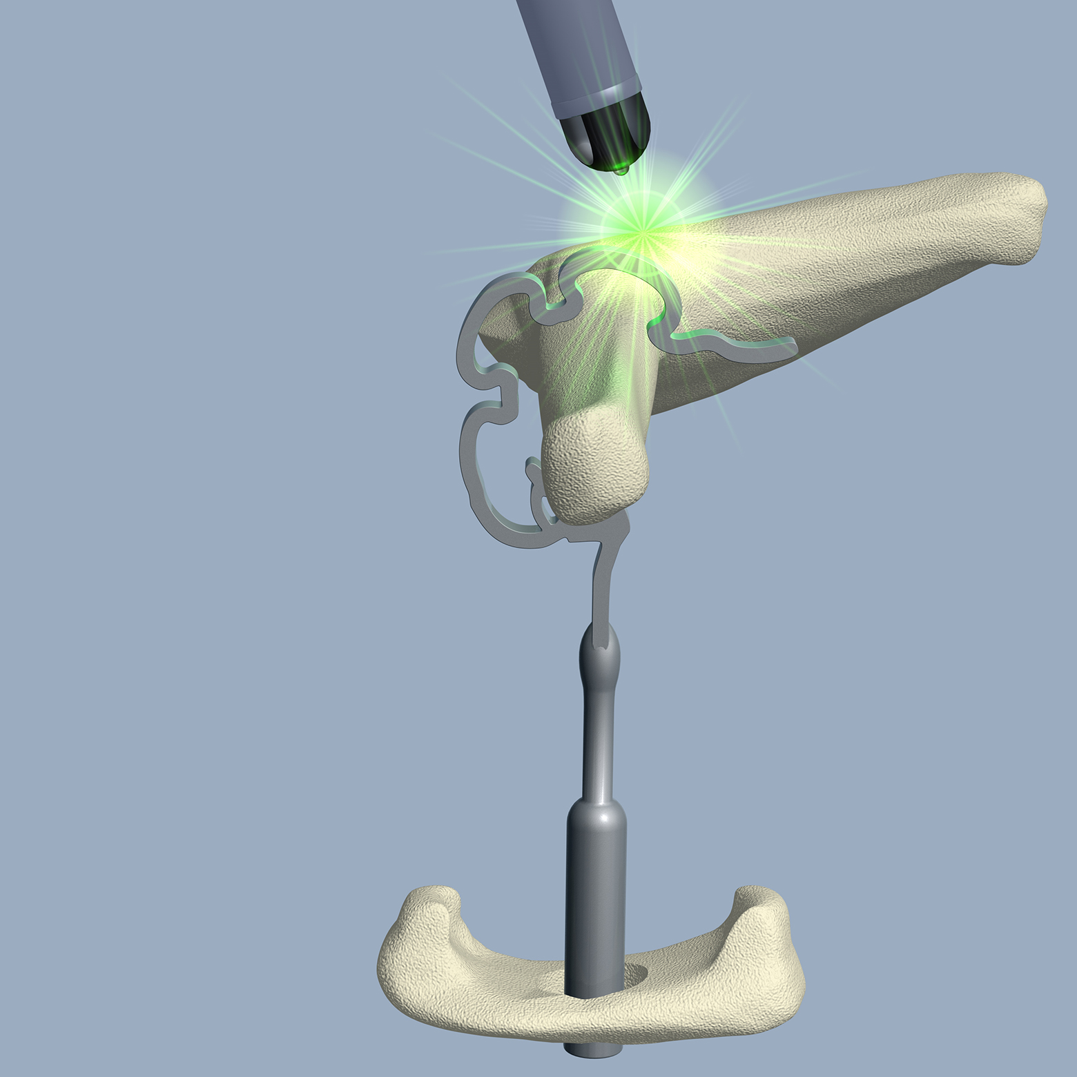 Entsprechend den Einstellwerten, die am Thermo-Dummy bestimmt wurden, erfolgt der erste Laserschuss auf die obere ThermoAktiv-Zone der Prothesenschlaufe. Entsprechend den Einstellwerten, die am Thermo-Dummy bestimmt wurden, erfolgt der erste Laserschuss auf die obere ThermoAktiv-Zone der Prothesenschlaufe.