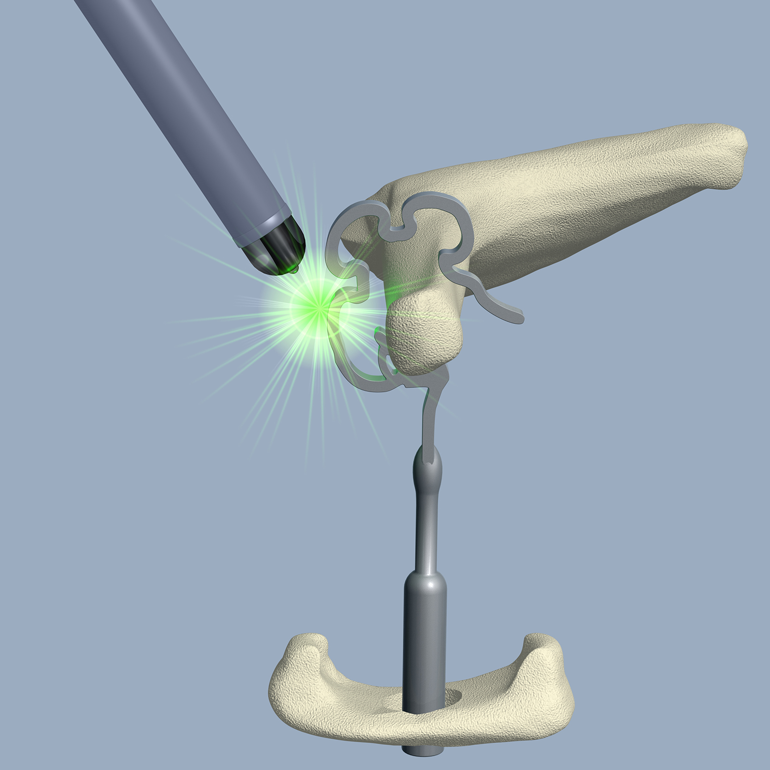 Anschließend wird die dritte Zone, die dem Schaft am nächsten ist, mit einem weiteren Schuss geschlossen. Anschließend wird die dritte Zone, die dem Schaft am nächsten ist, mit einem weiteren Schuss geschlossen.