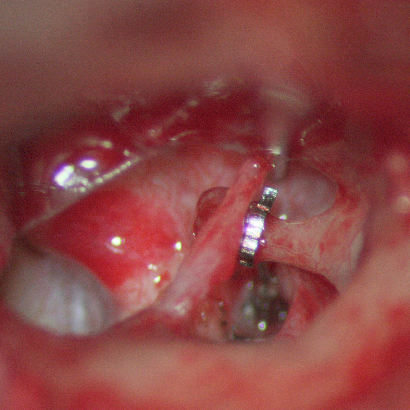 NiTiBOND in-situ NiTiBOND in-situ